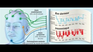 Troubles du sommeil et polysomnographie [upl. by Klug934]