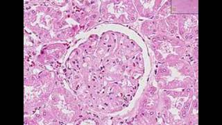 Histopathology Kidney Systemic lupus erythematosus [upl. by Annoerb]