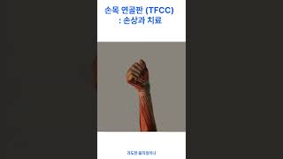 손목 연골판 삼각 연골 윤상체 TFCC  손상과 치료 [upl. by Amees161]