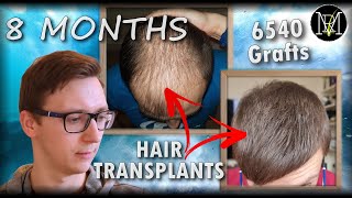 8 Months after 2nd Hair Transplant  6500 Grafts  Norwood 5 [upl. by Hutchison554]