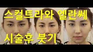 스컬트라 스컬트라붓기 엘란쎄 엘란쎄붓기 스컬트라와 엘란세의 붓기차이 [upl. by Chessy]