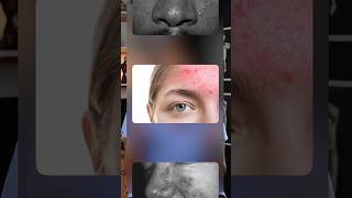 Acne Rosacea Explained acne rosacea [upl. by Four931]