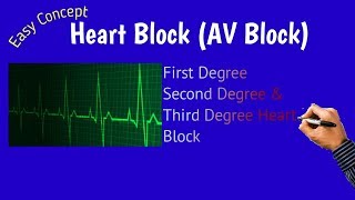 Heart Block  AV block Atrioventricular Block [upl. by Rella]