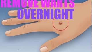 How to Get Rid of a Wart Overnight [upl. by Kira]