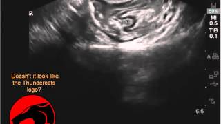 Pelvic pain diagnosis  intussusception [upl. by Dewhurst]