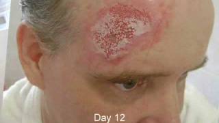 Time lapse video and pictures of Basal Cell Carcinoma removal skin cancer treatment no surgery [upl. by Elish605]