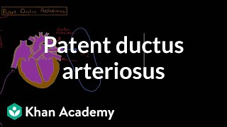 Patent ductus arteriosus  Circulatory System and Disease  NCLEXRN  Khan Academy [upl. by Rennat]