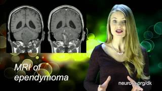 Ependymoma [upl. by Inilahs]