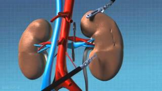 DaVinci Robotic Surgical System  Partial Nephrectomy Animation [upl. by Nealy633]