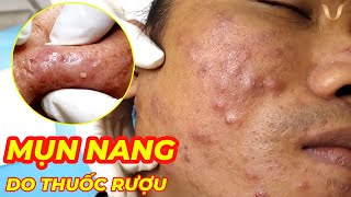 Điều trị mụn nang do thuốc rượu  Acne Treatment  Trị mụn hiệu quả tại TPHCM  Hiền Vân Spa 648 [upl. by Goodyear]