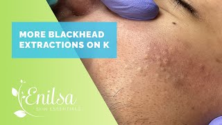 More Blackhead Extractions with K [upl. by Ploss889]