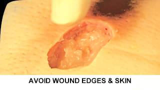 Enzymatic Debridement Demonstration Understand Wound Care [upl. by Ailedua]