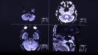 Chordoma  aggressively growing tumor in CT and MRI sequence english [upl. by Aleicarg]