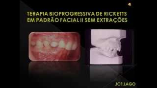 TERAPIA BIOPROGRESSIVA DE RICKETTS EM PADRÃO FACIAL II SEM EXTRAÇÕES [upl. by Quillon]