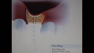 Sinus lift video using MISImplants Bone compression kit [upl. by Reilamag847]