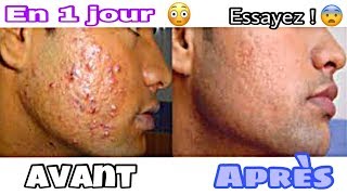 Comment supprimer LES BOUTONS DU VISAGE EN 1NUIT CA MARCHE VRAIMENT PROMIS🤫 [upl. by Nerraw]