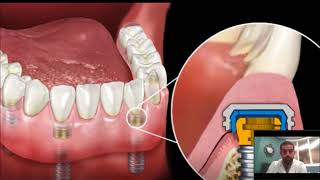 Dental Implant Overdenture  SnapIn Dentures [upl. by Ahsiela]