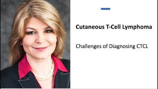 Challenges of Diagnosing CTCL Chapter 1 [upl. by Esorrebma]