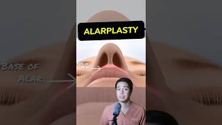 How to operate ALARPLASTY  TIP PLASTY  SurgeOn surgeon alarplasty tipplasty rhinoplasty fyp [upl. by Ahsilif]