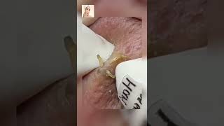 Blackheads Removal  Acne Treatment and Very Satisfying Satisfying Pimple pop blackheads [upl. by Lledyr]