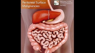 All About Peritoneal Tumours Causes Symptoms Diagnosis and Treatment [upl. by Valenba]