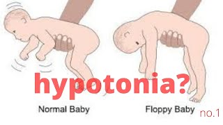 NDT Therapy in a Hypotonic quadriplegic child with Cerebral Palsy Easy handlings [upl. by Stovall]