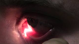 Ophthalmic Skills Video  Basics in Slit Lamp Examination [upl. by Yrffoeg]