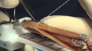 Hamstring Autograft Technique for ACL Reconstruction Surgery [upl. by Odracer]