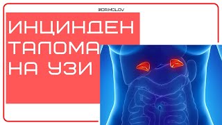 Инцинденталома на УЗИ почек аденома надпочечника [upl. by Eetnom252]