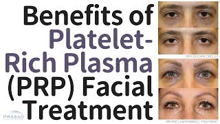 PRP Treatment For Face  How Is It Done  The Aesculpir  Best Cosmetic Treatments in Delhi [upl. by Cynthla]