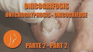 Onicogrifosis 2da parte podologiaintegral [upl. by Niarb]