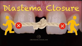 Diastema closure using direct bonding  front wing technique [upl. by Nnahteb447]