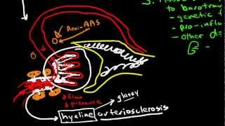 Pathophysiology of Hypertensive Nephropathy [upl. by Epifano]