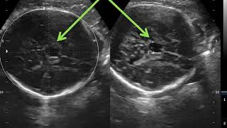 CASE 321 ENLARGED FETAL cavum septum pellucidum CSP 34WK [upl. by Aicenav891]