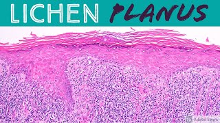 Lichen Planus amp Hypertrophic Lichen Planus Inflammatory Dermpath 101 for Dermatology amp Pathology [upl. by Romola]