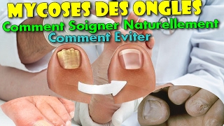 Mycoses des Ongles  Comment Soigner Naturellement amp Comment léviter [upl. by Azeel]