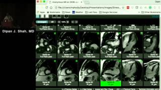 Stress MRI Methodology Current Role and Case Studies Dipan Shah MD December 13 2016 [upl. by Atiuqel189]