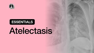 Atelectasis  Chest Radiology Essentials [upl. by Edbert]