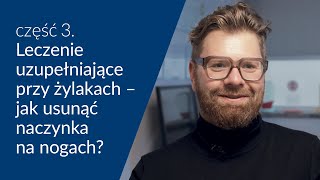 Leczenie uzupełniające przy żylakach  jak usunąć naczynka na nogach [upl. by Mayram]