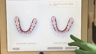 Scanner Intraorale Itero INVISALIGN [upl. by Burgess]