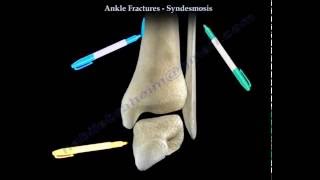 Ankle Fractures and the Syndesmosis  Everything You Need To Know  Dr Nabil Ebraheim [upl. by Nylekoorb]