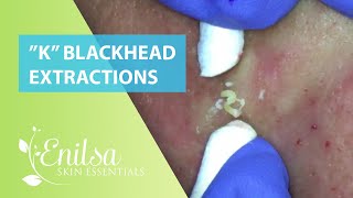 Blackheads Extractions “K’s” 8th Treatment [upl. by Cohlette]