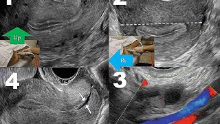 lecture 1  Introduction to GYNECOLOGICAL ultrasound [upl. by Main505]