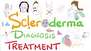 Scleroderma Diagnosis and Management [upl. by Zola]