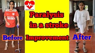 paralysis in a stroke improvement after exercises [upl. by Kremer]