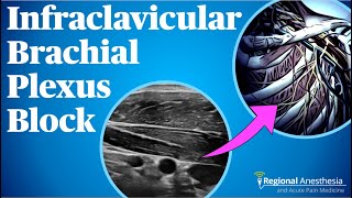 Infraclavicular Brachial Plexus Block [upl. by Fogarty540]