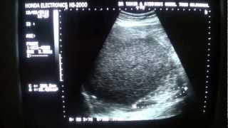 ULTRASOUND PERINEPHRIC ABSCESS RT [upl. by Aruol604]