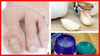 7 remèdes maison pour lutter contre les mycoses des ongles aux pieds et aux mains [upl. by Gausman]