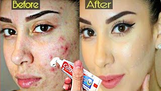 ये चीज सोने से पहले मात्र 2 मिनट तक लगा लो पुराने से पुराने Pimples भी होंगे खत्म\ Foracne treatment [upl. by Adnic]