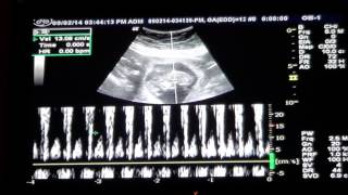 Baby 12 Week Ultrasound amp Heartbeat [upl. by Pyle]